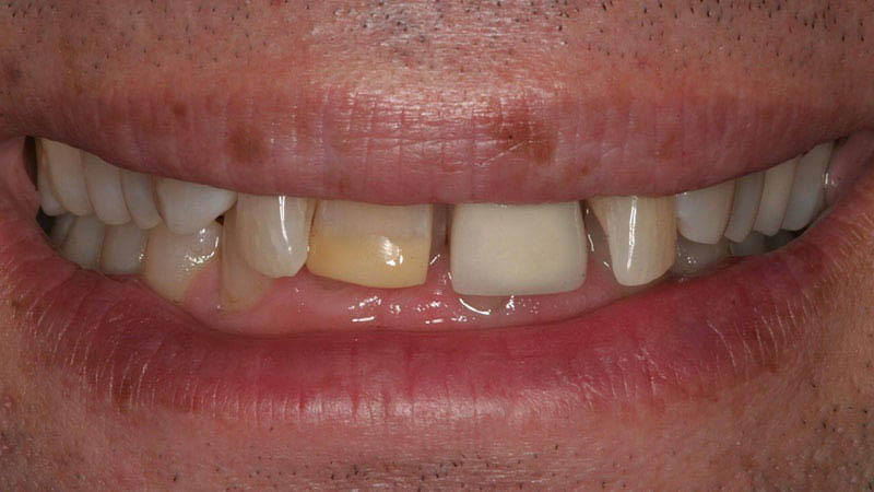 The image shows a close-up view of a person's face with a wide smile, revealing teeth with a noticeable gap between them.