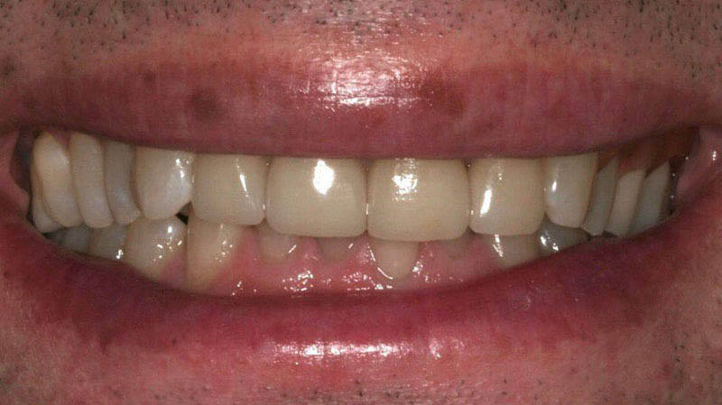 The image shows a person smiling with a mouth full of teeth, displaying an open smile.