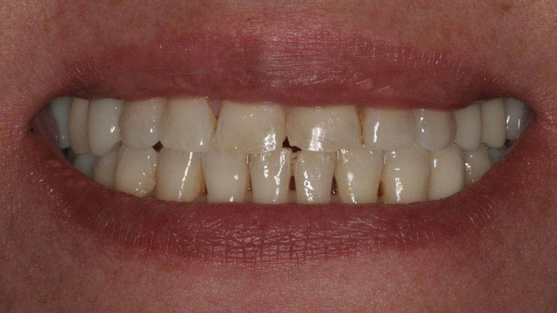 The image shows a close-up view of a person's teeth with a focus on their bottom teeth, which are prominently displayed against a backdrop of their lips and chin, highlighting the dental work including braces and possibly other orthodontic appliances.