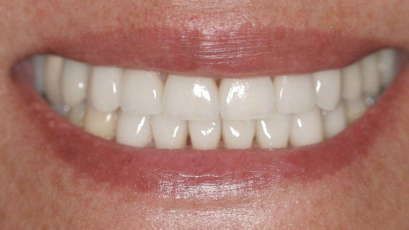 The image shows a close-up of a person's smiling face with visible teeth and lipstick, taken from a frontal perspective.