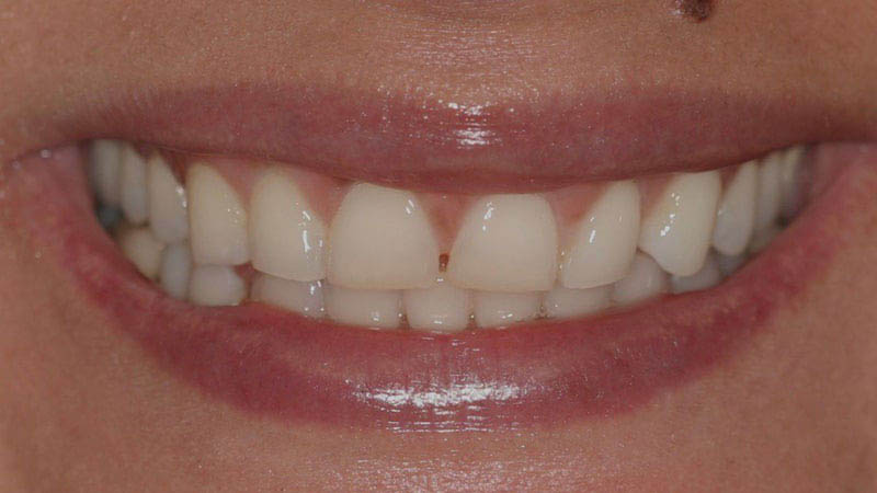 The image shows a close-up of a person's smiling face with straight teeth and lipstick applied.