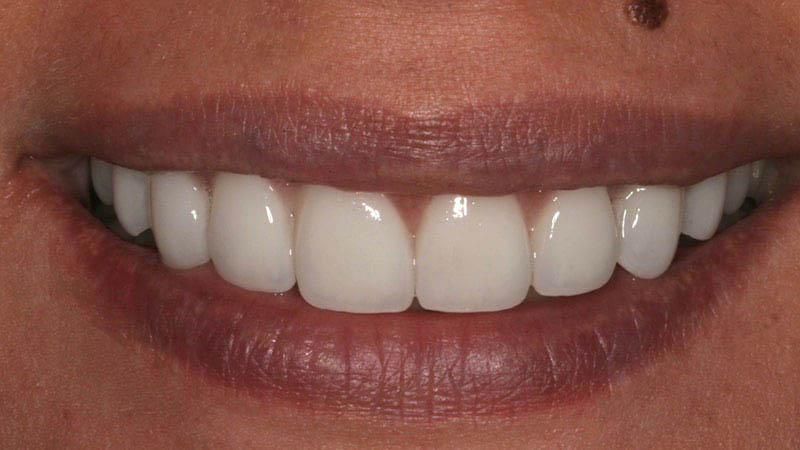 The image shows a close-up of a person's smiling mouth with white teeth, displaying their dental work including veneers or caps on the front teeth.