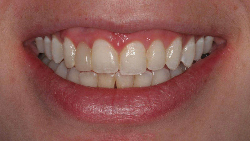 The image shows a close-up of a person's smiling mouth with white teeth, displaying their teeth and gums against a neutral background.