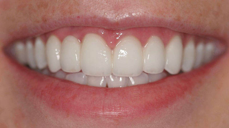 The image shows a person with a big smile displaying straight white teeth.