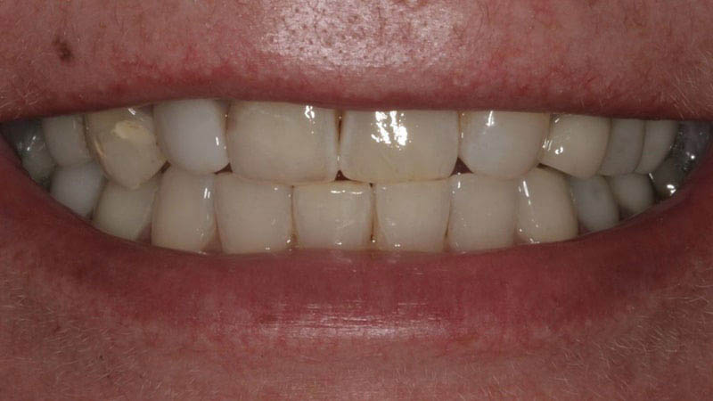The image shows a close-up of a person's teeth with a focus on their dental work, which includes a bridge or partial denture replacing one tooth.