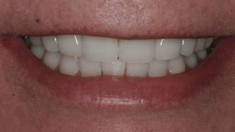 The image shows a close-up view of a person's smiling face, focusing on their teeth, which are white with a natural appearance.