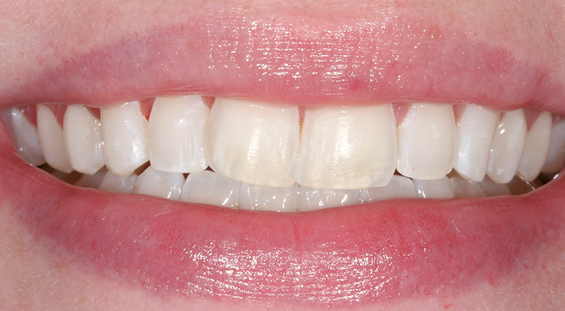 Metro Smiles | Dysport® Injections, Preventive Care and Laser Dentistry