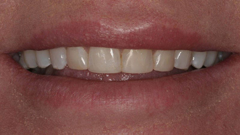 The image shows a close-up of a person's lower face with a broad smile, revealing white teeth and pink gums, against a neutral background.