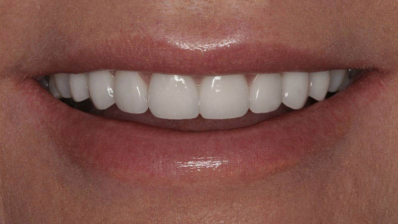 The image shows a close-up of a person's mouth with teeth, lips, and part of their chin visible; they appear to be smiling.