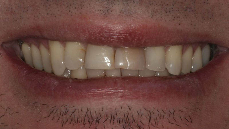 The image shows a close-up of a person's smiling mouth with visible teeth and gums, and a portion of their chin can be seen at the bottom of the frame.