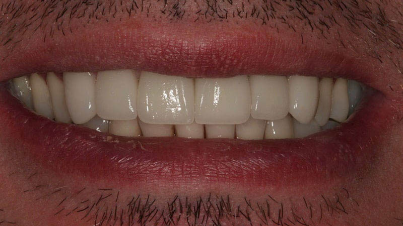 The image displays a close-up of a person's face with a large smile showing white teeth, set against a blurred background.