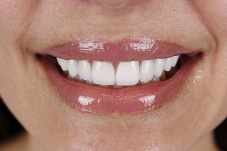Metro Smiles | Invisalign reg , Botox reg  Injections and No-Prep Veneers