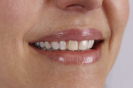 Metro Smiles | Other Services, Laser Dentistry and Invisalign reg 